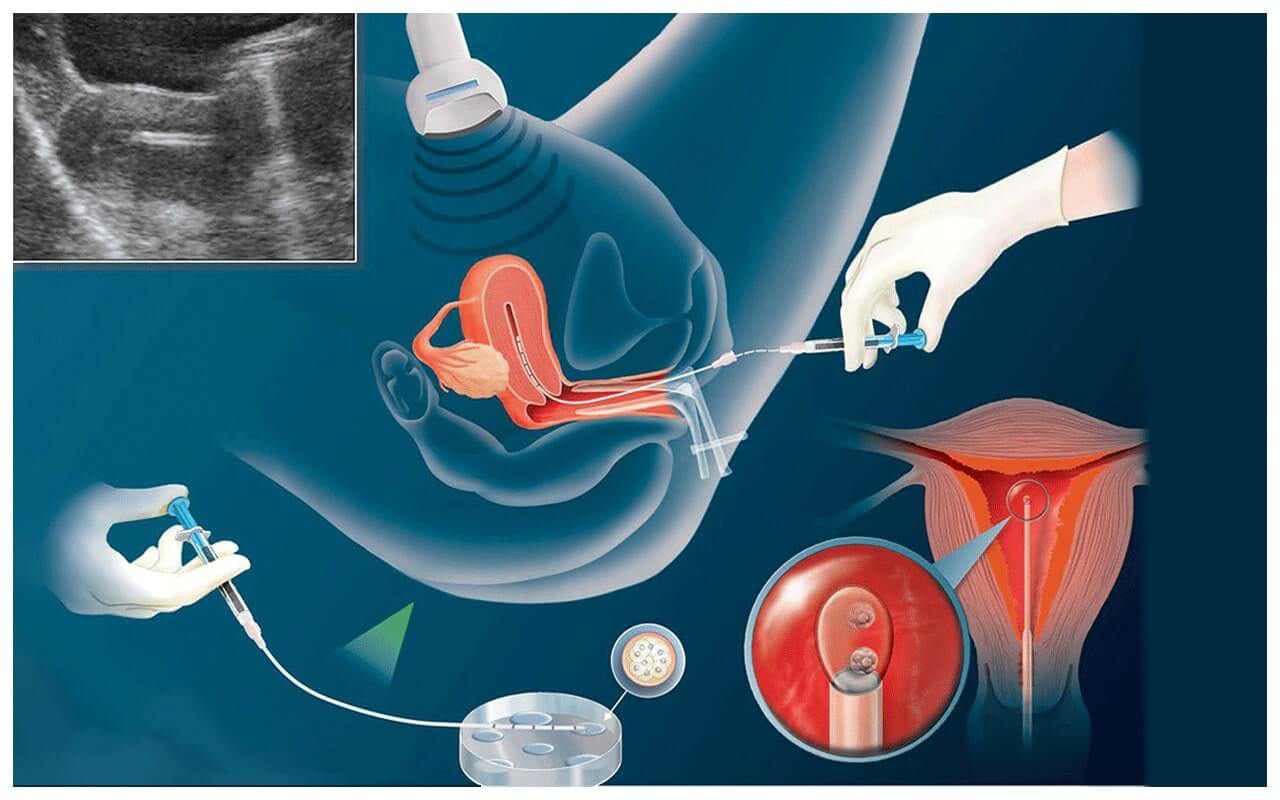 IUI fertility treatment consultation